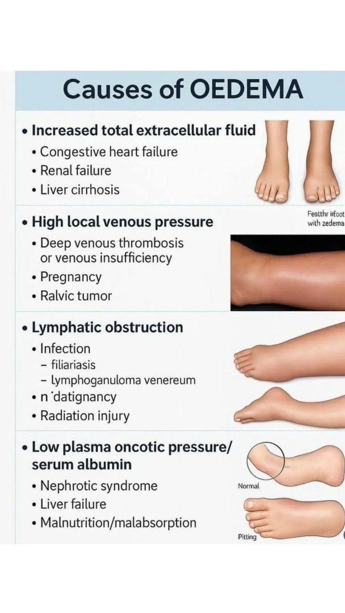 CAUSES OF OEDEMA
