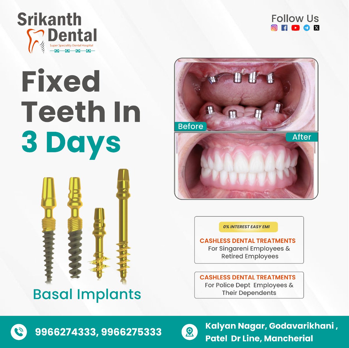SrikanthDental's tweet image. Struggling with missing teeth?

At Srikanth Dental, we provide Basal Implants that give you fixed teeth in just 3 days! 🦷

✅ Before &amp;amp; After results
✅ Cashless treatments
✅ 0% EMI options

📍 Godavarikhani | Mancherial

#srikanthdental #basalimplants
