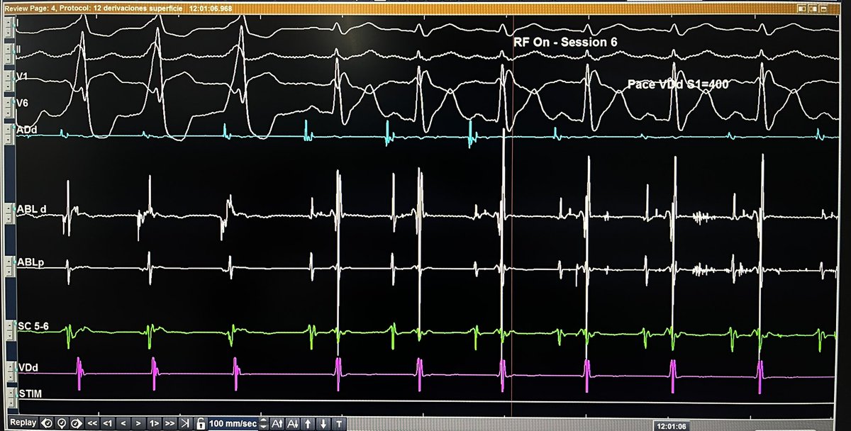 ALFIEEP1's tweet image. #WPW
20 yom pt w/ parahisian manifest high risk AP.

Intermittent condition over AP during procedure.

ABL target with AV ratio 1/4 to 1/3 was unsuccessful to ablate AP.

Kent automaticity seen during mapping &amp;amp; ablated with AV ratio 1/2 led to successful RFA.

Tough call.