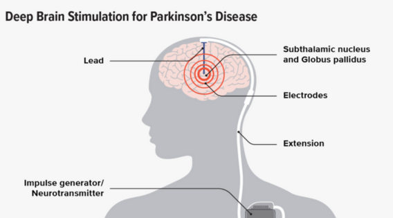 drsujoysanyal's tweet photo. DBS Surgeon Insights: The Future of DBS Surgery for Parkinson’s Disease in Kolkata https://t.co/QYmAD3VjrD
#lifeafterdbs #sucessofdbs #brainpacemaker #canditateofdbs #dbskolkata #dbsforadvancedparkinsonsdisease #leadingdbssurgeon #neurosurgeon #neurosurgery #brainsurgeon #DBS https://t.co/3Hy4yD0fdm