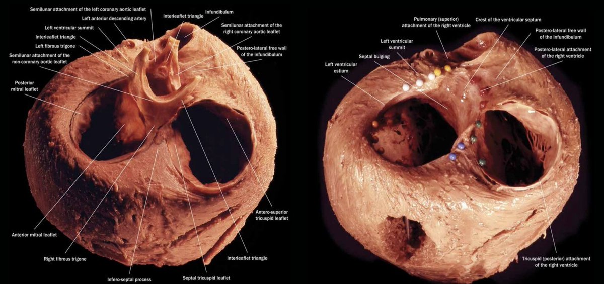 Left and right ventricles, clearly presented!
