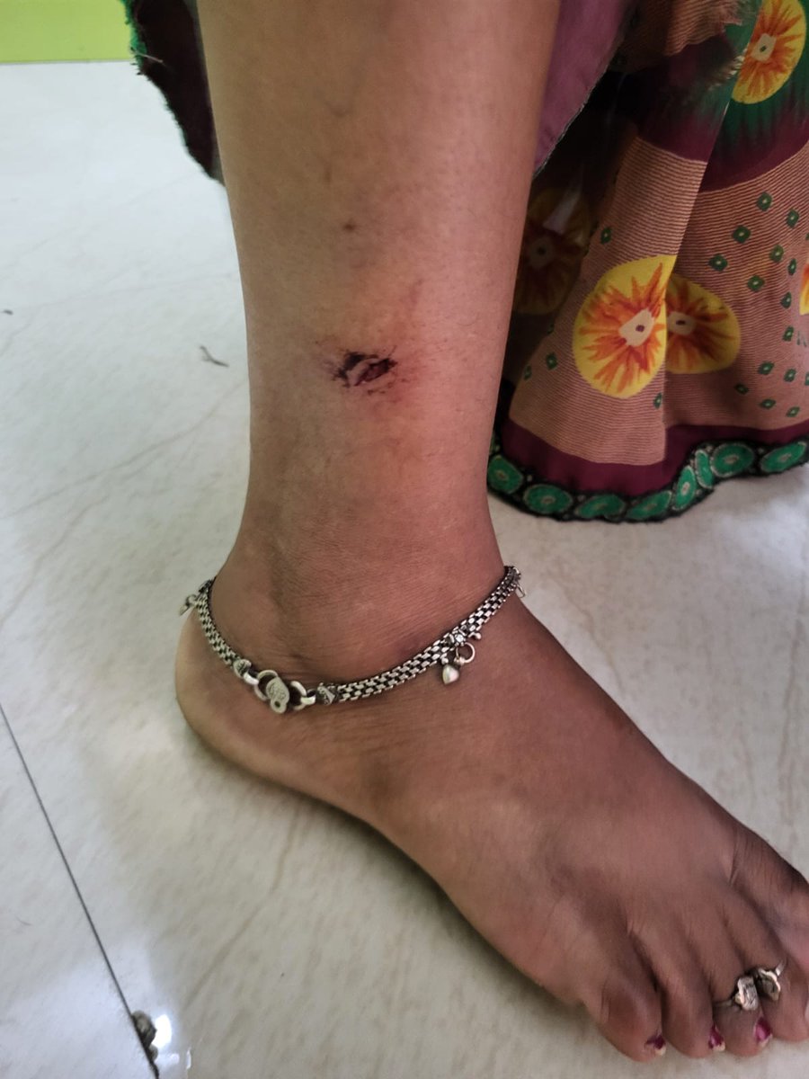 Praveen Vikram Singh (@praveen_singh5) on Twitter photo ग्रेटर नोएडा वेस्ट के इकोविलेज 3 में स्ट्रीट डॉग ने मेड पर किया हमला
ग्रेटर नोएडा वेस्ट: सुपरटेक इकोविलेज-3 सोसायटी में बुधवार को एक काले रंग के स्ट्रीट डॉग ने मेड रंजीता पर हमला कर दिया और काट लिया। इस घटना के बाद से सोसायटी में रहने वाले लोगों में डर और नाराजगी का माहौल है। ग्रेटर नोएडा वेस्ट के इकोविलेज 3 में स्ट्रीट डॉग ने मेड पर किया हमला
ग्रेटर नोएडा वेस्ट: सुपरटेक इकोविलेज-3 सोसायटी में बुधवार को एक काले रंग के स्ट्रीट डॉग ने मेड रंजीता पर हमला कर दिया और काट लिया। इस घटना के बाद से सोसायटी में रहने वाले लोगों में डर और नाराजगी का माहौल है।