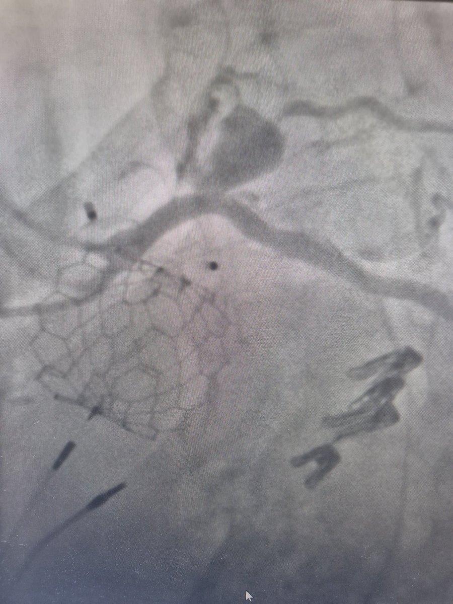Elad Asher (@asherelad) on Twitter photo Modern cardiology...
<a href="/PCRonline/">PCRonline 🫀</a> @Sbrugaletta <a href="/Ortega_Paz/">Luis Ortega Paz</a> @Anazmicalik @guilbom <a href="/hect2701/">Prof. Hector M. Garcia-Garcia</a> <a href="/NicolaRyanI1/">Nicola Ryan</a> <a href="/DrPascalMeier/">Pascal Meier,MD</a> @W_jyg <a href="/ICigalini/">Ignacio Cigalini 🇦🇷</a> <a href="/Hragy/">Hany Ragy</a> <a href="/SABOURETCardio/">SABOURETCardiologist</a>
<a href="/mmamas1973/">Mamas A. Mamas</a> <a href="/djc795/">David J. Cohen, MD, MSc</a> <a href="/GreggWStone/">Gregg W. Stone MD</a> <a href="/toreyj01/">James Torey PA-C</a> <a href="/EAPCIPresident/">EAPCIPresident</a> <a href="/CMichaelGibson/">C. Michael Gibson MD</a> <a href="/SmithElliotjs/">Elliot Smith</a> <a href="/ArielRoguin/">Ariel Roguin</a> <a href="/aayshacader/">Aaysha Cader</a> Modern cardiology...
<a href="/PCRonline/">PCRonline 🫀</a> @Sbrugaletta <a href="/Ortega_Paz/">Luis Ortega Paz</a> @Anazmicalik @guilbom <a href="/hect2701/">Prof. Hector M. Garcia-Garcia</a> <a href="/NicolaRyanI1/">Nicola Ryan</a> <a href="/DrPascalMeier/">Pascal Meier,MD</a> @W_jyg <a href="/ICigalini/">Ignacio Cigalini 🇦🇷</a> <a href="/Hragy/">Hany Ragy</a> <a href="/SABOURETCardio/">SABOURETCardiologist</a>
<a href="/mmamas1973/">Mamas A. Mamas</a> <a href="/djc795/">David J. Cohen, MD, MSc</a> <a href="/GreggWStone/">Gregg W. Stone MD</a> <a href="/toreyj01/">James Torey PA-C</a> <a href="/EAPCIPresident/">EAPCIPresident</a> <a href="/CMichaelGibson/">C. Michael Gibson MD</a> <a href="/SmithElliotjs/">Elliot Smith</a> <a href="/ArielRoguin/">Ariel Roguin</a> <a href="/aayshacader/">Aaysha Cader</a>