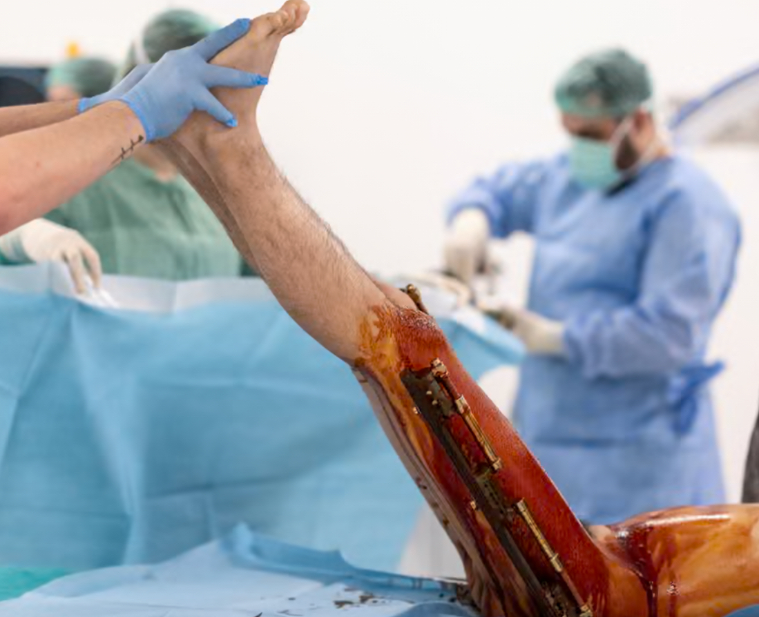 Mark Henley (@mrmarkhenley) on Twitter photo The men paying thousands to get their legs broken – and lengthened theguardian.com/lifeandstyle/2… #cosmeticsurgery #leglengthening <a href="/guardian/">The Guardian</a> The men paying thousands to get their legs broken – and lengthened theguardian.com/lifeandstyle/2… #cosmeticsurgery #leglengthening <a href="/guardian/">The Guardian</a>