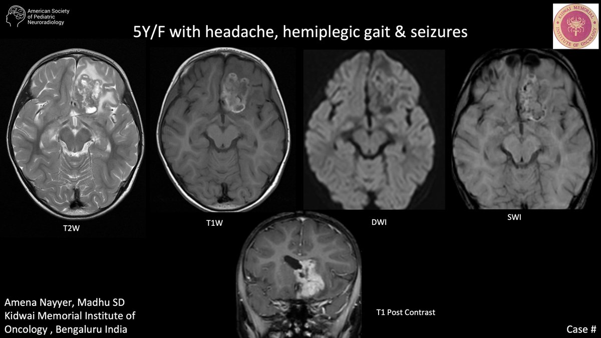 Case of the week: 5Y/F with headache, hemiplegic gait &amp; seizures bit.ly/3Ju2aHt Amena Nayyer, Madhu SD, Kidwai Memorial Institute of Oncology , Bengaluru India#PediNeuroRad #MedEd #FOAMrad #PedsRad