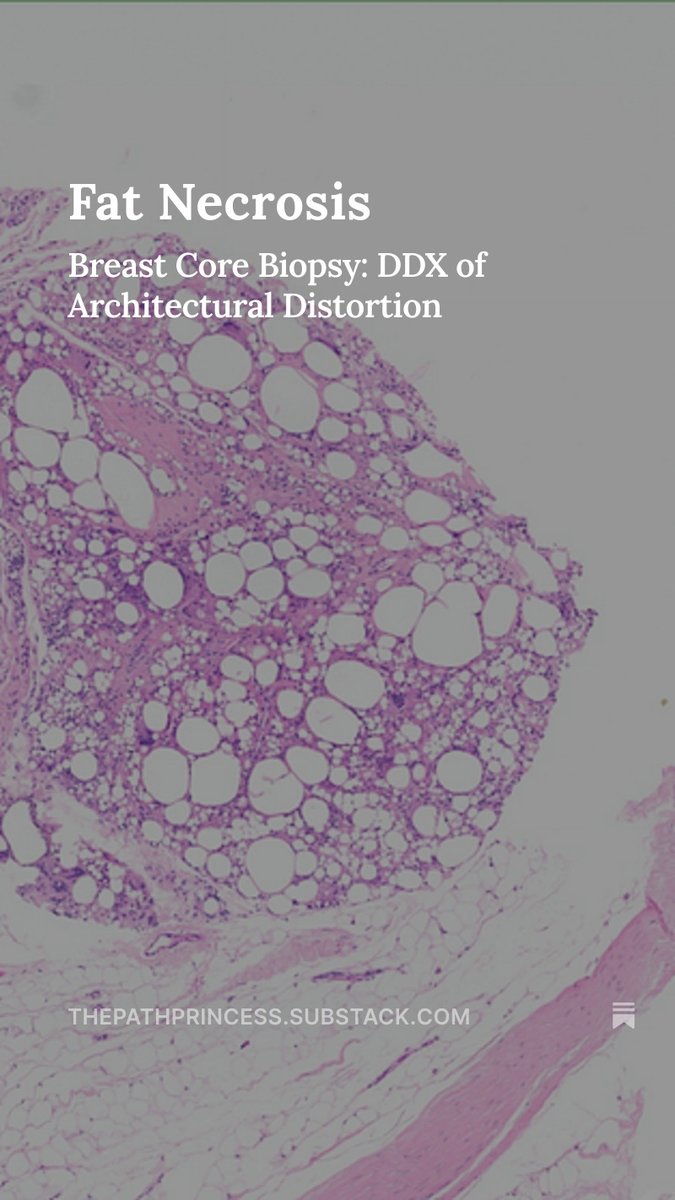 Architectural distortion caused by fat necrosis. An example of how benign processes can mimic malignancy.

thepathprincess.substack.com/p/fat-necrosis…

Always consider the patient's clinical history alongside the microscopic findings. 📷 

#pathology #pathologist #pathX #pathtwitter #breastpath