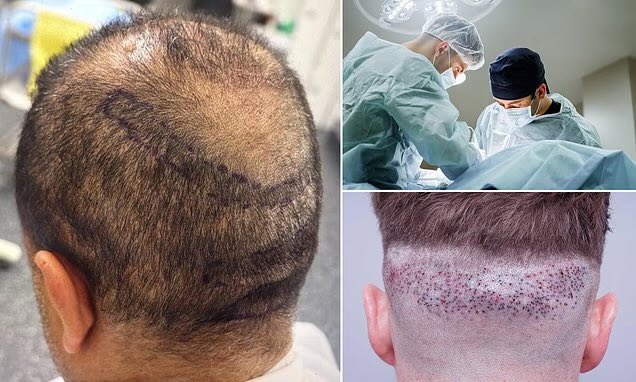 🚨 Our President Chris D’Souza is quoted in this article warning of black market hair transplant procedures being carried out in the UK by rogue unlicensed technicians with no medical degree 
dailymail.co.uk/health/article… 

Learn more about the dangers of black market surgery abs how