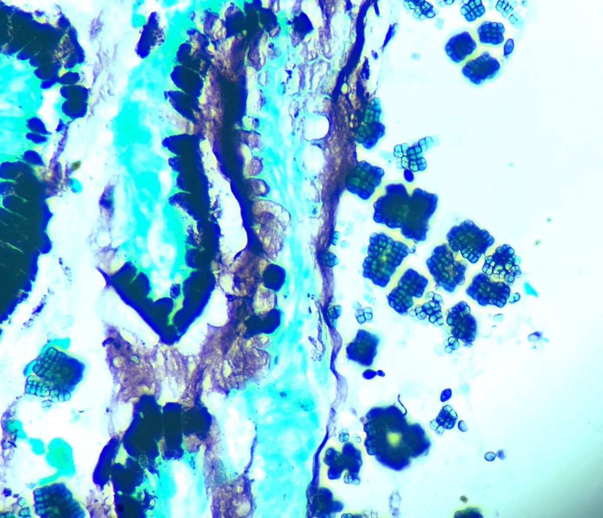 garreyf's tweet image. Gastric biopsy. Nice example.