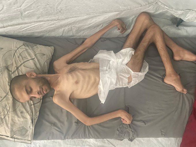 AbujomaaGaza's tweet photo. Ramadan Na’og | 

DISABLED &amp; MALNOURISHED https://t.co/M9EVKL86QD