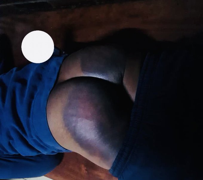 Stephen Sarkozy Chuma 🇿🇼 (@chumasteve) on Twitter photo This is <a href="/ARTUZ_teachers/">Amalgamated Rural Teachers Union of Zimbabwe,ARTUZ</a> Secretary General <a href="/robohchere/">Robson Chere</a> after being tortured by state security agents following their arrest on 31 July last year. Today, Chere, <a href="/cdegwenzi/">Councilor Samuel Gwenzi</a> & <a href="/namataik_/">Namatai Kwekweza🇿🇼</a> were found not guilty by the courts. This is why we must organize & remove this regime! This is <a href="/ARTUZ_teachers/">Amalgamated Rural Teachers Union of Zimbabwe,ARTUZ</a> Secretary General <a href="/robohchere/">Robson Chere</a> after being tortured by state security agents following their arrest on 31 July last year. Today, Chere, <a href="/cdegwenzi/">Councilor Samuel Gwenzi</a> & <a href="/namataik_/">Namatai Kwekweza🇿🇼</a> were found not guilty by the courts. This is why we must organize & remove this regime!
