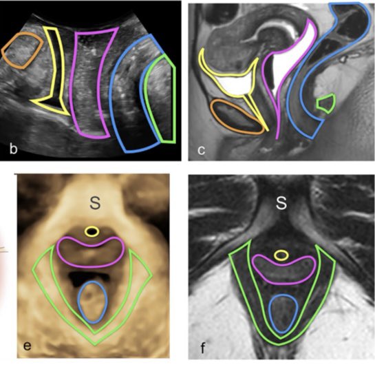 lucianachamiec1's tweet photo. Available now our new publication on translabial US in pre- and postoperative assessment of midurethral slings for stress urinary incontinence https://t.co/5Ti96q3TLu