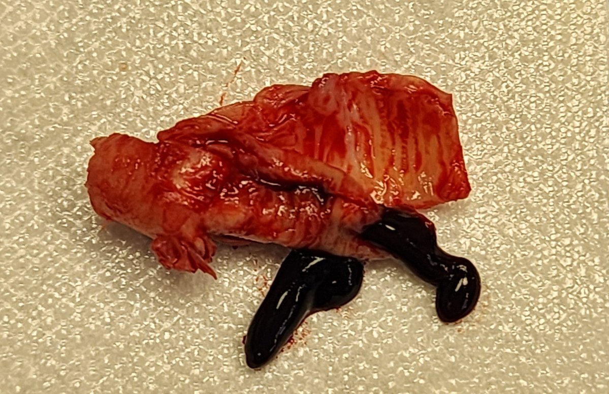 Sabalbal MD (@mahersabalbal) on Twitter photo Patient with stroke in evolution. Acute ICA thrombus. Endo here would have been bad, real bad. <a href="/canuc_57/">Greg Hayes</a> <a href="/farkomd/">frank arko</a> <a href="/westleyohman/">Westley Ohman</a> <a href="/AWBeckMD/">Adam W. Beck</a> <a href="/VascularSVS/">Society for Vascular Surgery</a> Patient with stroke in evolution. Acute ICA thrombus. Endo here would have been bad, real bad. <a href="/canuc_57/">Greg Hayes</a> <a href="/farkomd/">frank arko</a> <a href="/westleyohman/">Westley Ohman</a> <a href="/AWBeckMD/">Adam W. Beck</a> <a href="/VascularSVS/">Society for Vascular Surgery</a>