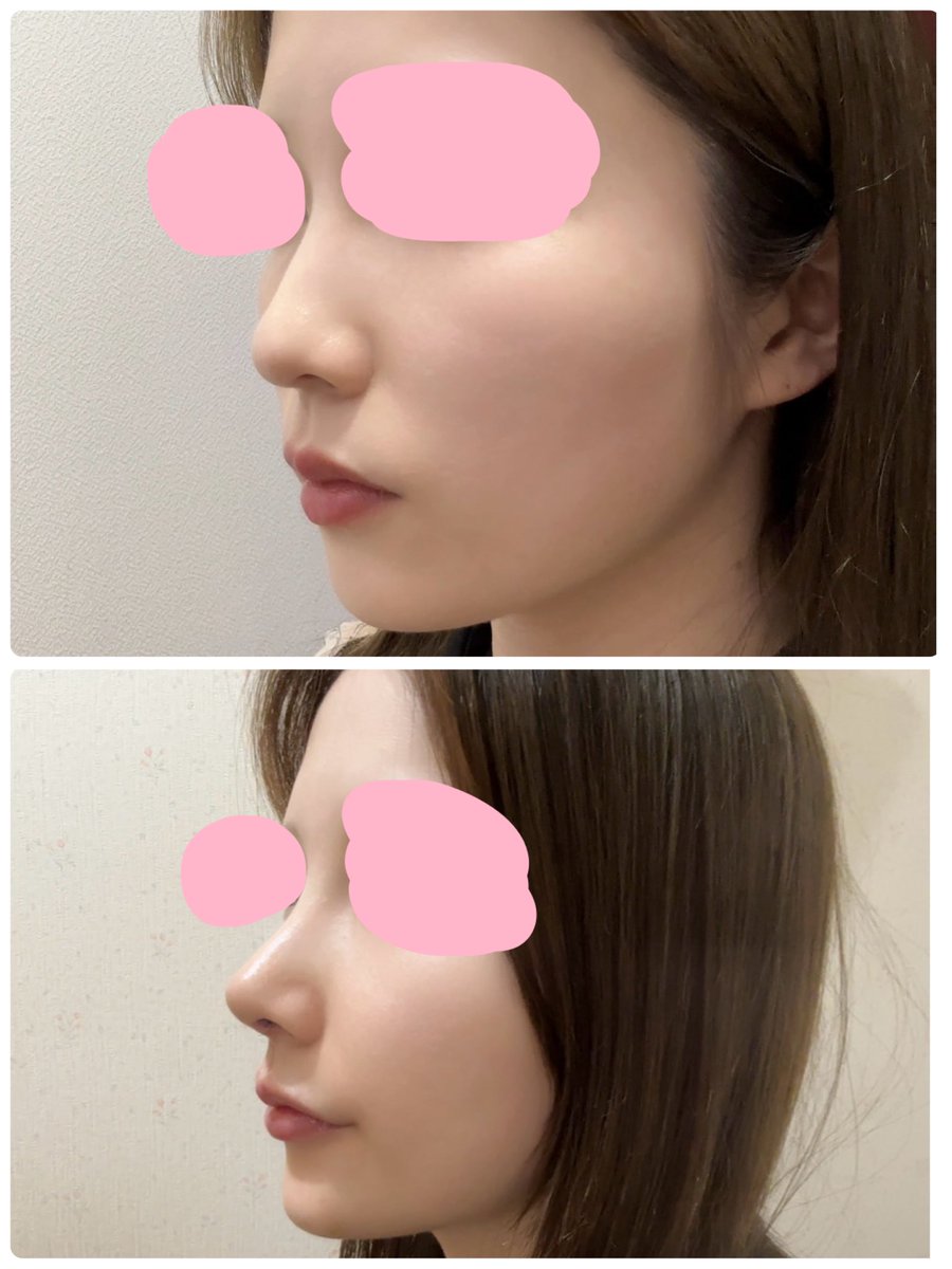 MelonRiu's tweet photo. 8/9にZESTAR美容外科さん（@zestarps ）で鼻の施術をしてきました〜！
内容は鼻先（プロテーゼ無し）、骨切り幅寄せ、鼻柱矯正、鷲鼻矯正です🕊️💞 https://t.co/mn6njKomaC