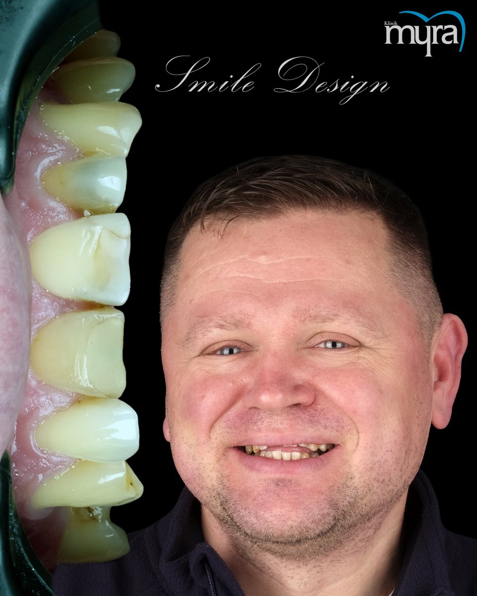 myradental's tweet image. Sebastian’s New Smile, New Life 🦷✨
From missing teeth to zirconium perfection:
 ✔️ 6 Implants
 ✔️ 28 Crowns
 ✔️ Bone grafts + sinus lift
Esthetics meets digital precision.
 🌐 myradental.co.uk
#SmileMakeover #DentalImplants #TeethTransformation #TurkeyDentist #MyraDental