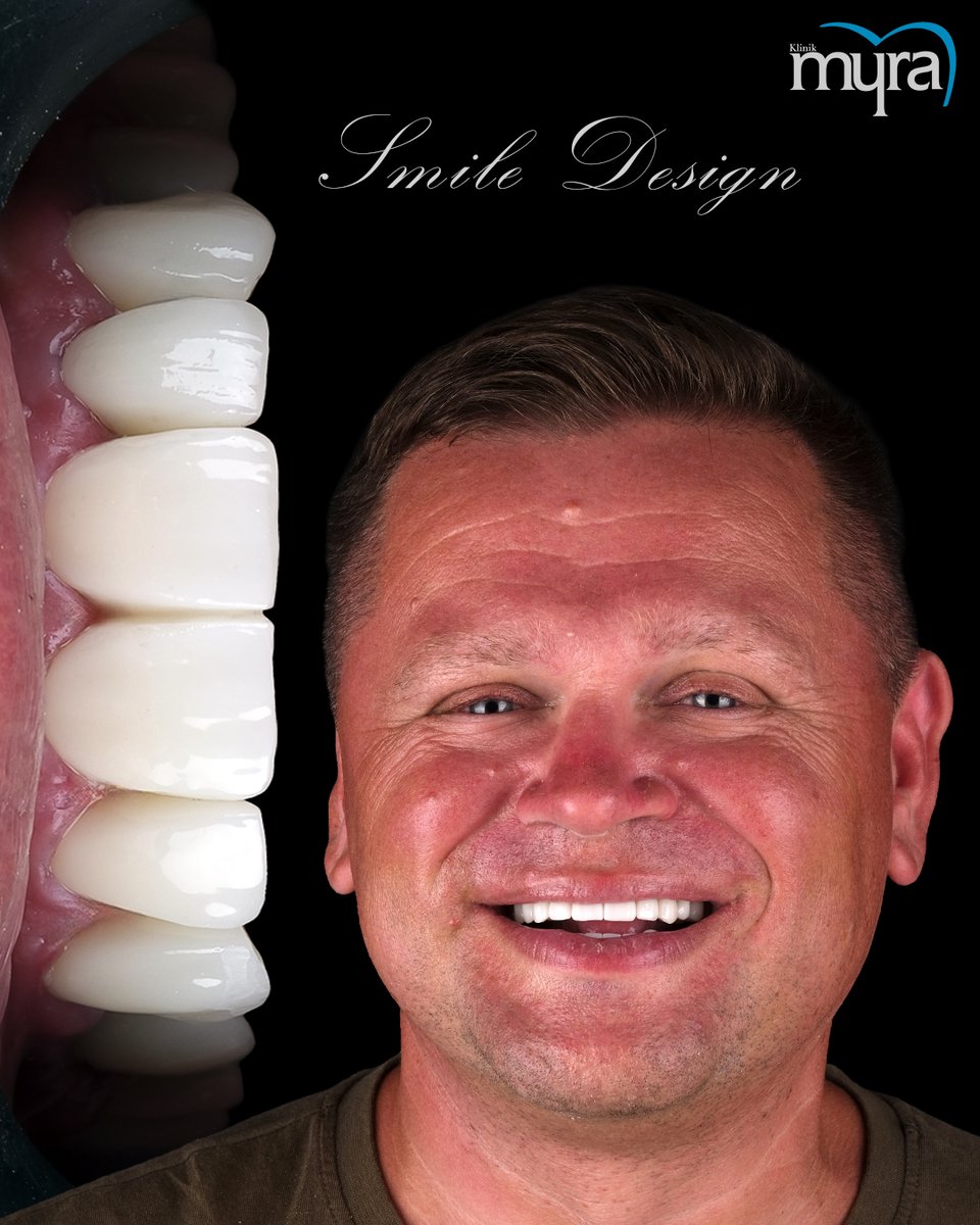 myradental's tweet image. Sebastian’s New Smile, New Life 🦷✨
From missing teeth to zirconium perfection:
 ✔️ 6 Implants
 ✔️ 28 Crowns
 ✔️ Bone grafts + sinus lift
Esthetics meets digital precision.
 🌐 myradental.co.uk
#SmileMakeover #DentalImplants #TeethTransformation #TurkeyDentist #MyraDental