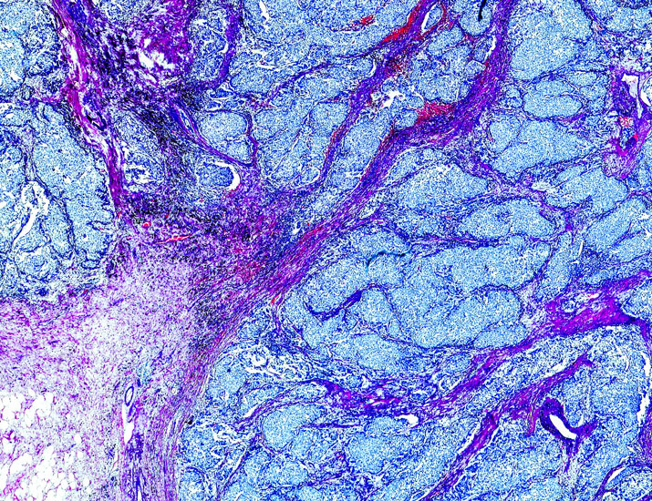 scisignal's tweet image. Analyzing #TNBC cells, a team finds the transcription factor Hox-C12 supports metastasis by connecting beta2-ARs to a calcium-cAMP loop and show that HOXC12 expression correlates with worse survival in patients. @MIPS_Australia @Dr_MLHalls @TerranceLamm scim.ag/45nKIgw