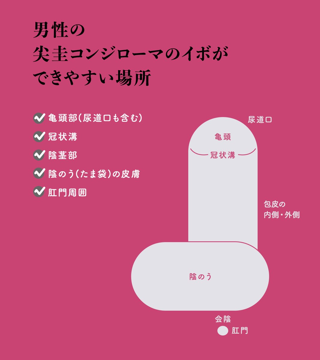 男性と女性で違う？尖圭コンジローマができやすい場所まとめ！

#性病 #HIV #HPV #尖圭コンジローマ #梅毒  #性教育 #健康相談