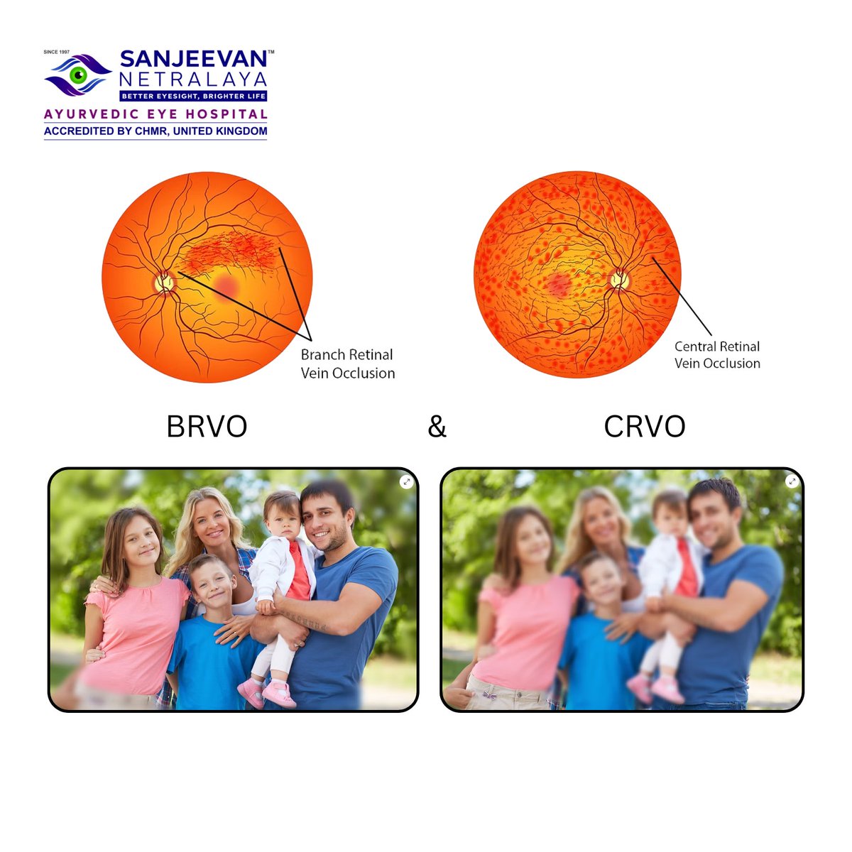 SanjeevanN4891's tweet image. 🌿 Retinal Vein Occlusion (BRVO &amp;amp; CRVO) – Ayurvedic Herbal Treatment to Restore Vision

📞 WhatsApp: +91 98451 81288

🌐 Website: sanjeevannetralaya.com

🏥 Sanjeevan Netralaya – Ayurvedic (Herbal) Eye Hospital, Internationally Accredited by CHMR, UK

 #brvo #crvo #retinal