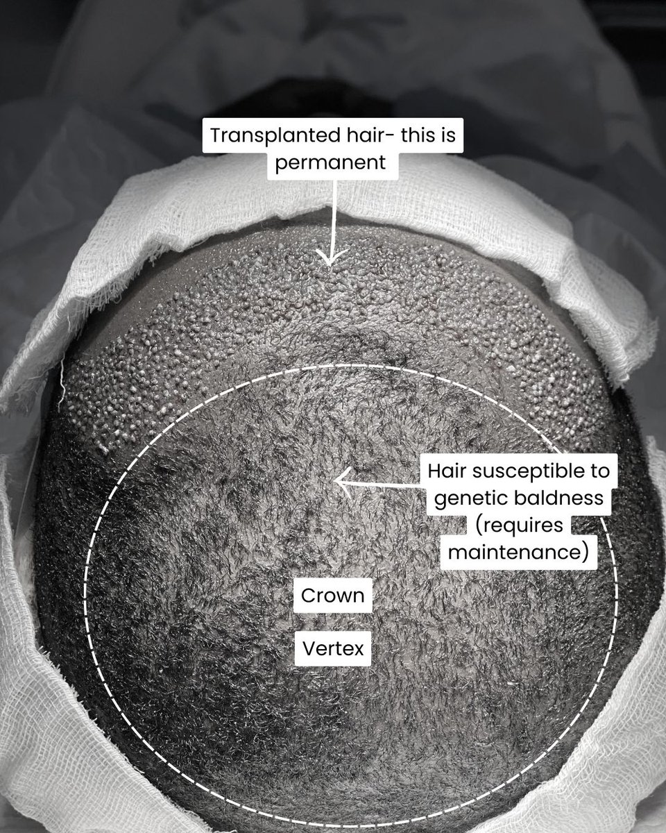 <a href="/Qhaleel_/">Qhaleel</a> A hair transplant moves healthy, permanent hair follicles from the back of the scalp to thinning or balding areas. However, the existing, non-transplanted hair in the recipient area is still susceptible to male pattern baldness.