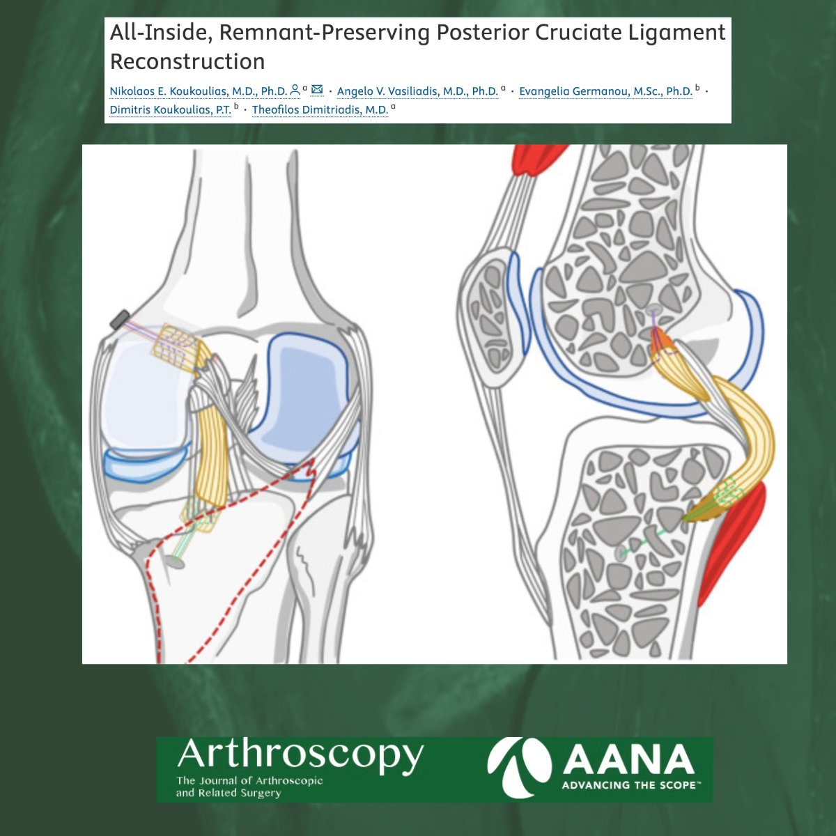 Arthroscopy Journal (@arthroscopyj) on Twitter photo All-Inside, Remnant-Preserving Posterior Cruciate Ligament Reconstruction
#PCLReconstruction #OrthopedicSurgery #SportsMedicine
<a href="/nkoukoulias/">Nikolaos Koukoulias</a>
ow.ly/Zth850WPejT All-Inside, Remnant-Preserving Posterior Cruciate Ligament Reconstruction
#PCLReconstruction #OrthopedicSurgery #SportsMedicine
<a href="/nkoukoulias/">Nikolaos Koukoulias</a>
ow.ly/Zth850WPejT