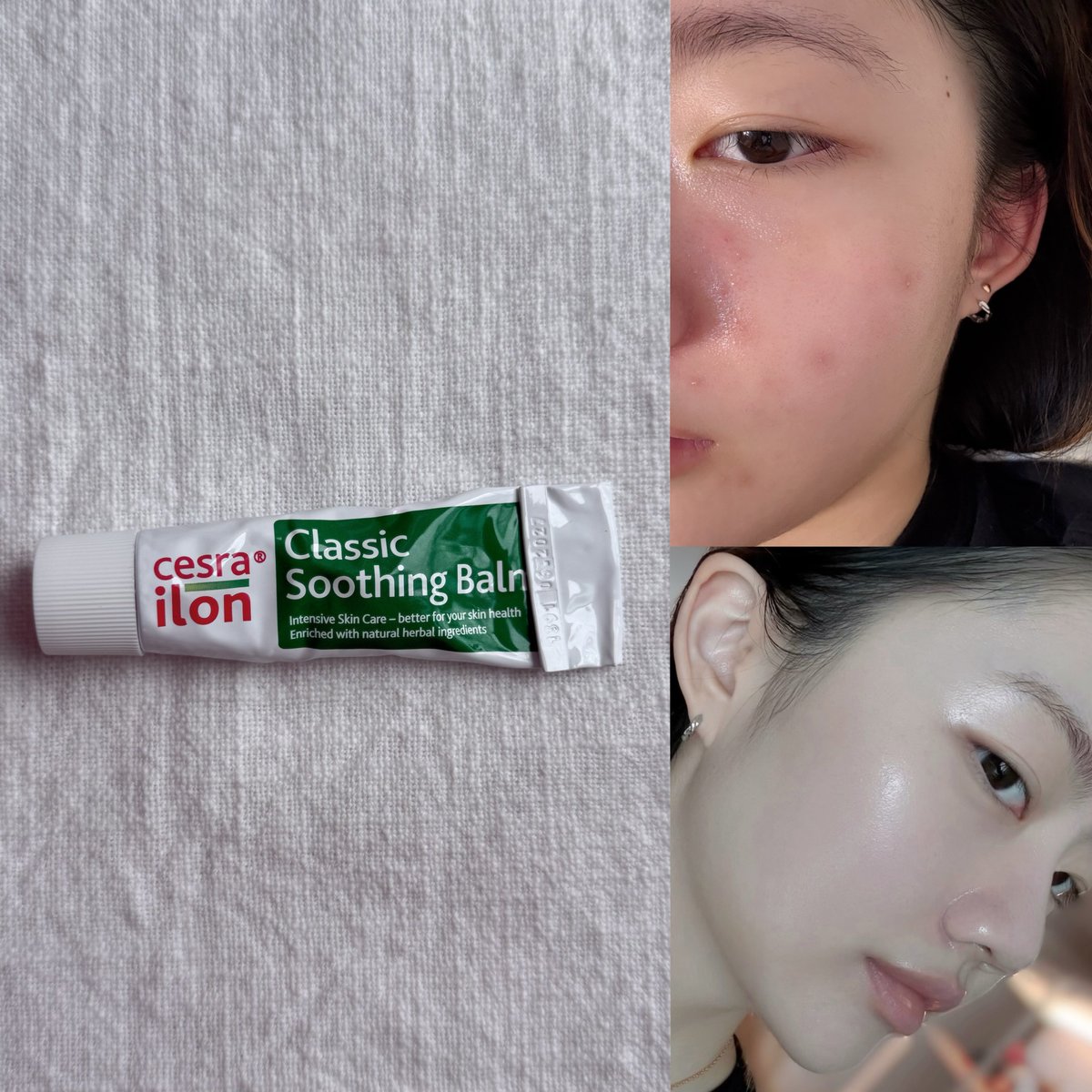 Surgical Outcomes of Levator Resection in Ptosis Patients with Deep  Superior Sulcus, image size:1200x1200