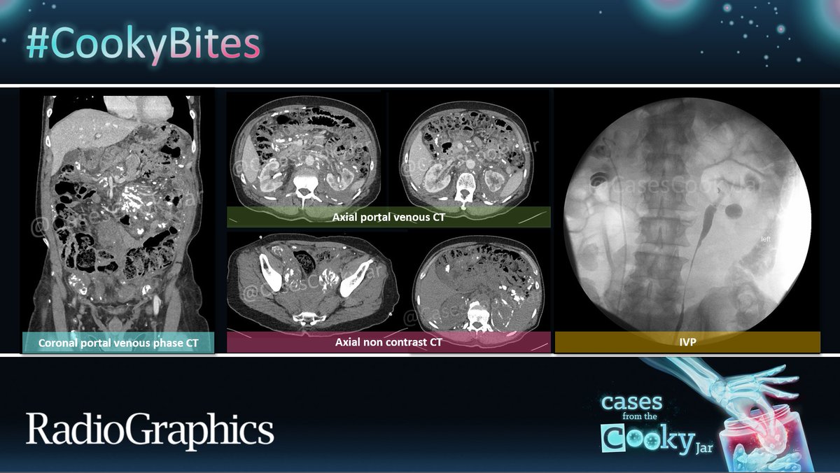 CasesCookyJar's tweet image. 55 M with failure to thrive presenting with fatigue and weight loss.
What is the diagnosis?

We’ll post the answer in 24h. Share companion cases with us using #CookyBites #229. We will RT the best cases!

#RGphx @cookyscan1 @RadioGraphics