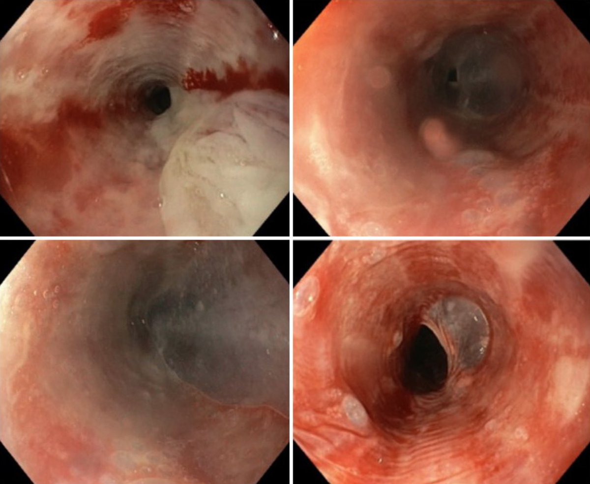 #MartesREED 
👩‍⚕️ Mujer de 42 años previamente sana                                                                         💬 Acude por presentar hematemesis tras ingerir alimentos