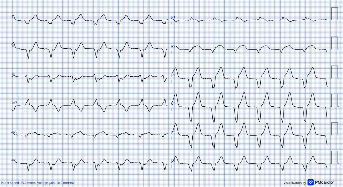leonr (@leonrmail) on Twitter photo 70y Man, CP. I got some nice ECGs for you😬What's happening? Culprit? <a href="/ecgandrhythmRoe/">Dr. Andreas Roeschl</a> <a href="/amalmattu/">Amal Mattu</a> <a href="/MertAvsever/">Mert Avsever</a> <a href="/koggelnoggel/">Jana Borucka</a> <a href="/TheECGMedic/">Jack Cahill</a> <a href="/Frances98392343/">Cciari1</a> <a href="/DrRazi4/">Dr Razi</a> <a href="/lila_enis/">Enis Lila</a> <a href="/Ecgloverr/">Pedram</a> <a href="/EcgOxford/">🫀EcgOxford</a> <a href="/ECGWeekly/">ECGWeekly</a> <a href="/EM_RESUS/">Sam Ghali, M.D.</a> <a href="/PMcardioApp/">PMcardio—AI that reads ECGs</a> <a href="/RobertHermanMD/">Robert Herman, MD, PhD</a> <a href="/smithECGBlog/">Stephen W. Smith</a> 70y Man, CP. I got some nice ECGs for you😬What's happening? Culprit? <a href="/ecgandrhythmRoe/">Dr. Andreas Roeschl</a> <a href="/amalmattu/">Amal Mattu</a> <a href="/MertAvsever/">Mert Avsever</a> <a href="/koggelnoggel/">Jana Borucka</a> <a href="/TheECGMedic/">Jack Cahill</a> <a href="/Frances98392343/">Cciari1</a> <a href="/DrRazi4/">Dr Razi</a> <a href="/lila_enis/">Enis Lila</a> <a href="/Ecgloverr/">Pedram</a> <a href="/EcgOxford/">🫀EcgOxford</a> <a href="/ECGWeekly/">ECGWeekly</a> <a href="/EM_RESUS/">Sam Ghali, M.D.</a> <a href="/PMcardioApp/">PMcardio—AI that reads ECGs</a> <a href="/RobertHermanMD/">Robert Herman, MD, PhD</a> <a href="/smithECGBlog/">Stephen W. Smith</a>