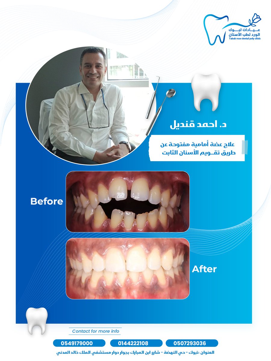 tabuk_dental1's tweet image. إنجازتنا اليومية مستمرة 🤞
علاج عضة أمامية مفتوحة عن طريق تقويم الأسنان الثابت 🦷

الإنجاز تم علي يد  الدكتور أحمد قنديل✔️
◀️اخصائي تقويم الأسنان
◀️ماجستير جامعة القاهرة
◀️زميل جامعة Bonn بالمانيا