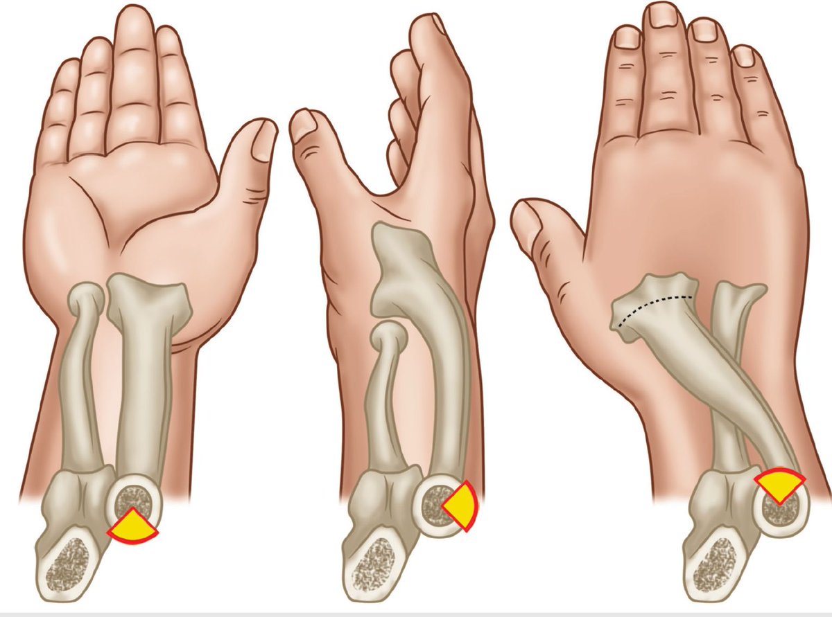 MoAImam's tweet image. The “safe zone” for internal fixation of the radial head/neck. There is a nonarticulating portion of the radial head (highlighted in yellow) in which it is safe to place hardware without the risk of impingement. This safe zone is centered straight lateral with the forearm…