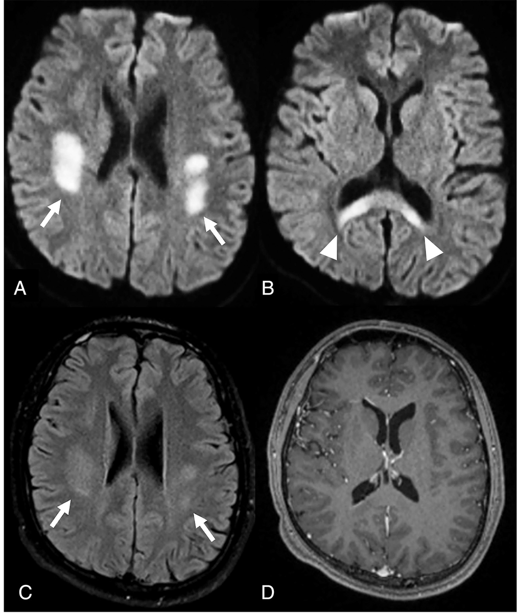Neurographics (@asnrographics) on Twitter photo From the July-September 2025 Issue of #Neurographics: Recurrent Stroke-Like Episodes in X-Linked Charcot-Marie-Tooth Type 1 Disease: Characteristic Brain MRI Findings ow.ly/W9vt50WITmU From the July-September 2025 Issue of #Neurographics: Recurrent Stroke-Like Episodes in X-Linked Charcot-Marie-Tooth Type 1 Disease: Characteristic Brain MRI Findings ow.ly/W9vt50WITmU