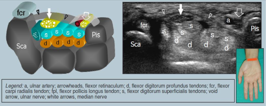 SportsMedReview's tweet image. The closed fist sign evaluates for carpal tunnel syndrome with a sensitivity of 61% and specificity of 92%! Click/ follow to learn more!

Watch: wikism.org/Closed_Fist_Si…

Read: youtube.com/watch?v=WYLlt3…

#SportsMedicine #Orthopedics #PhysicalTherapy #AthleticTraining #Rehab…