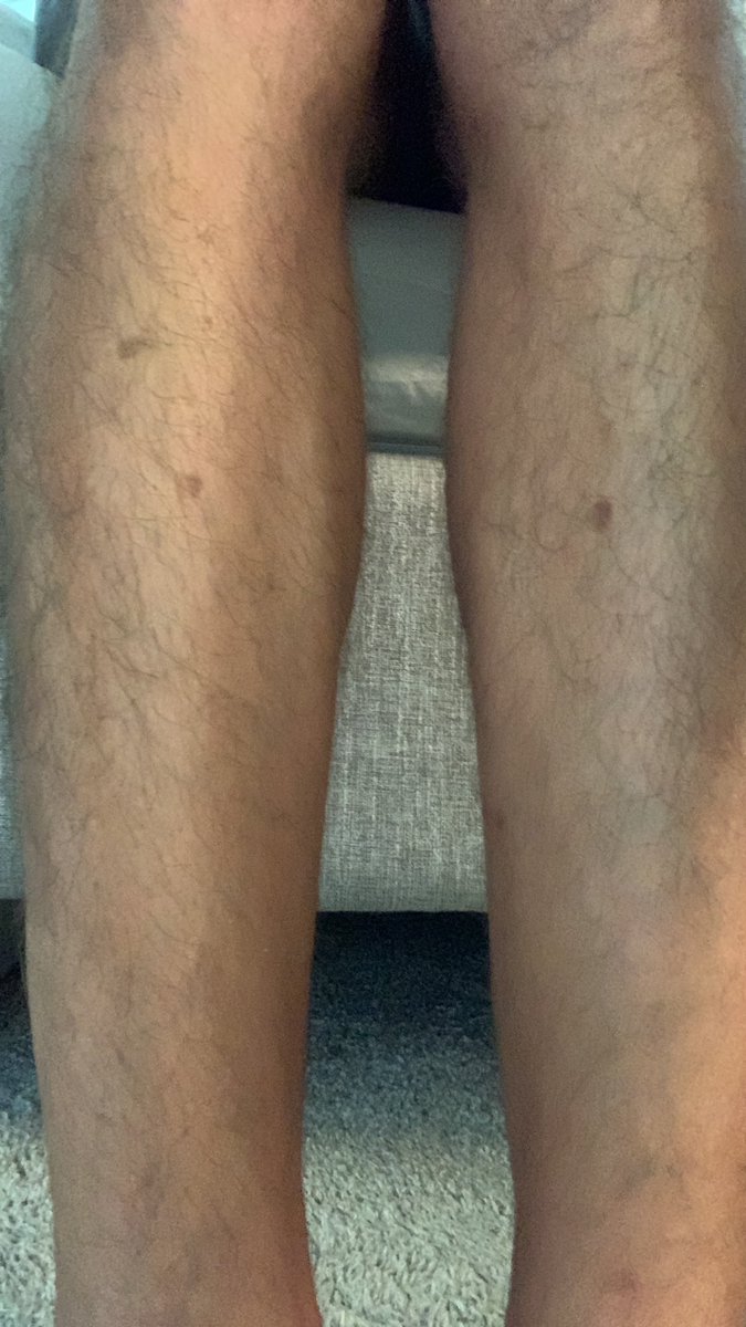 klouved's tweet photo. @franciscellis Pictured here are my shins. The dark spots are deep, embedded scars from previously owning one of these type beds - scars which are ~5-15 years old that I assume will never go away.

You WILL smash a shin at some point, MMW. To Francis and everyone else… you’ve been warned. https://t.co/gSy3EEosYx