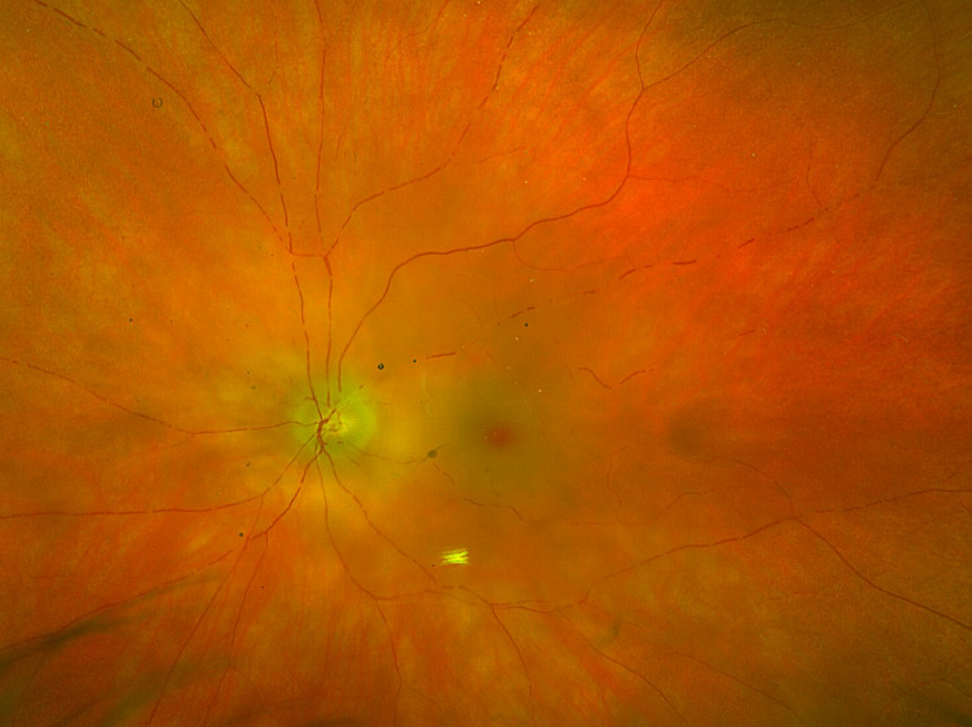 Man in his 80's presents with a central retinal artery occlusion. Note cherry red spot and boxcarring.