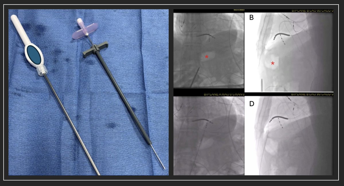 JICE (@jice_ep) on Twitter photo 🚨Latest #FreeRead in <a href="/JICE_EP/">JICE</a>
Use of S-ICD Tunneling Tool for Percutaneous Epicardial Access during VT Ablation
🧐📖rdcu.be/eDJLY
by <a href="/Jackson_J_Liang/">Jackson Liang</a>, <a href="/tontokavanich/">Nithi Tokavanich</a> & Frank Bogun
#EPeeps 🚨Latest #FreeRead in <a href="/JICE_EP/">JICE</a>
Use of S-ICD Tunneling Tool for Percutaneous Epicardial Access during VT Ablation
🧐📖rdcu.be/eDJLY
by <a href="/Jackson_J_Liang/">Jackson Liang</a>, <a href="/tontokavanich/">Nithi Tokavanich</a> & Frank Bogun
#EPeeps