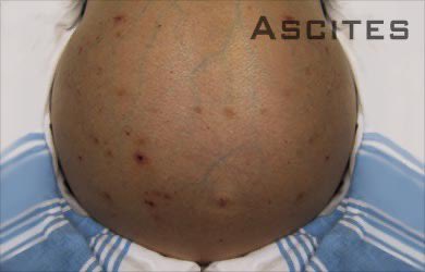 SenBillCassidy's tweet image. People objecting to hepatitis B vaccination apparently have never treated patients like this. Their life ending with a terrible liver disease or else requiring a transplantation. This is about preventing illnesses like this. I have the experience of treating patients infected…