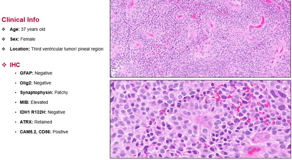 Methylation Case of the Week:

37 year old female patient with a pineal region tumor. Please Take your time Pondering the gene and Region of the case for the diagnosis. bonus question: can you PreTENd to guess the mutant gene in this case? #Neuropath #Pathology #Pathtwitter