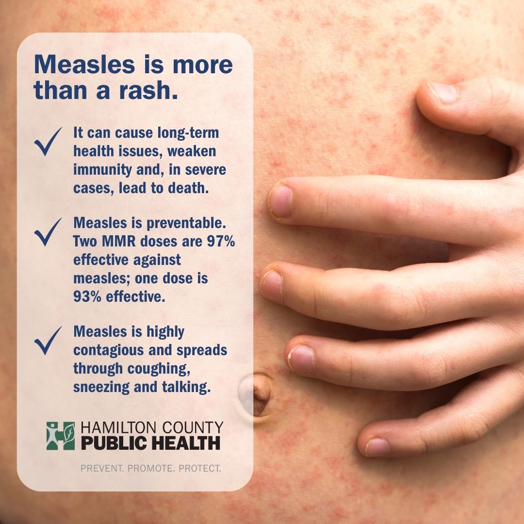 #Measles is a serious illness, highly contagious and can cause severe illness.

The MMR vaccine is safe &amp; effective:
1 dose = 93%
2 doses = 97%

Make sure kids are up to date on routine vaccinations and talk to a doctor about any questions or concerns.