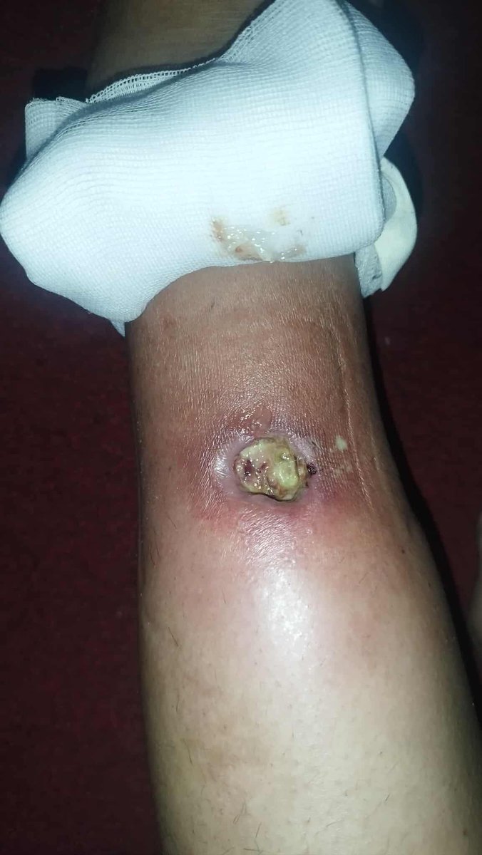 This is my son's foot. His wound is getting worse every day, and I can't afford treatment. The pain is eating away at his foot, and I am powerless to treat it. Your prayers and support may save his life. 💔 #SaveMySon 🙏
🙏 Please save my son, please 🙏
chuffed.org/project/132014…