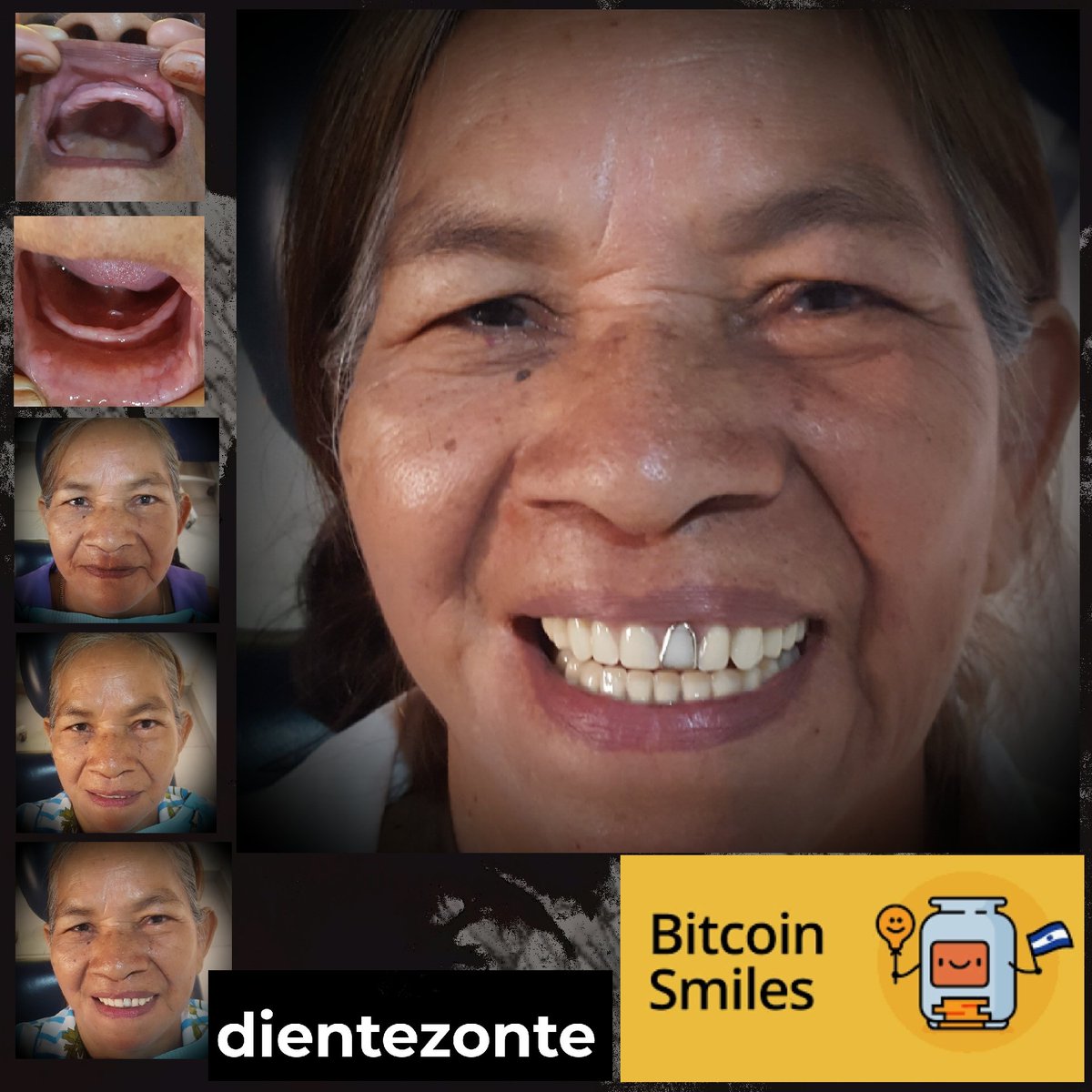 During her clinical examination, we also found severe boneloss in her maxillas. ⛑ But thanks to BTC, Demetria has been rehabilitated with new set of dentures and can now smile confidently. We continue bringing smiles to 🇸🇻.
Bitcoin fixes teeth! 🦷🦷🦷🦷