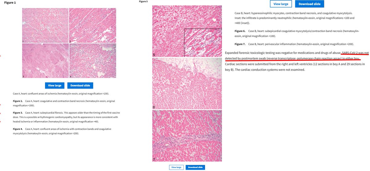 🚨Two teenage boys died suddenly in their sleep/found dead in bed 3-4 days following 2nd dose Pfizer mRNA COV-19 vaccine, without resuscitation attempts.
Both negative for S-CoV-2. Neither had cardiac symptoms (silent death), yet heart injury seen in their "postvaccine hearts",