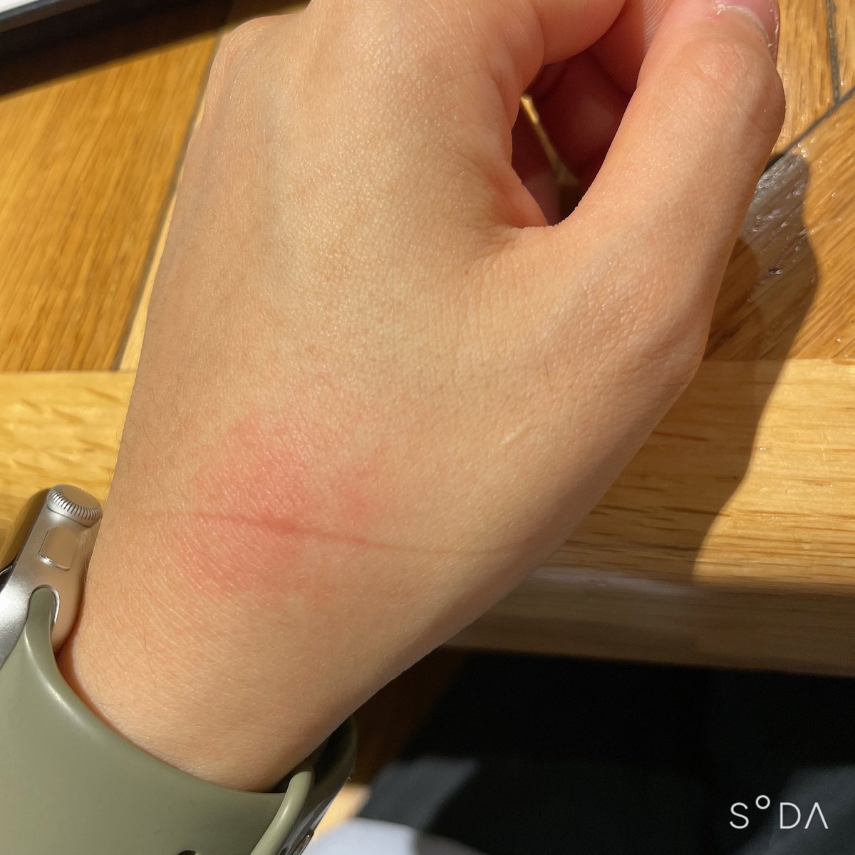 いつもの癖で、手を太ももの下に挟んだら凄く痒くなったから見た。

この前、蚊に刺された部分でした( ´◔‸◔`)

こうさ、いかにも「刺されました」感が見えてくると、忘れてた痒さも出てくるわけです…(っ◞‸◟c)

かゆい……っ！