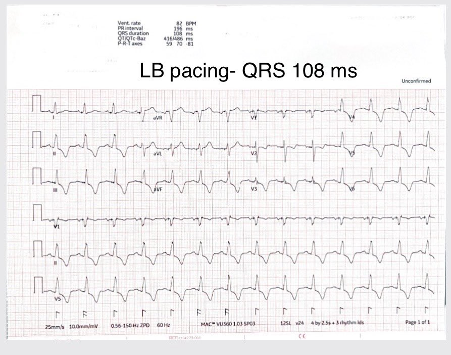 Optimal BIV pacing and LB pacing. Does it matter how you get there ?