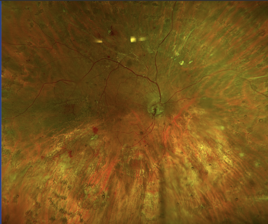 Preop and one week postop following vitrectomy, membrane peeling, endolaser, silicone oil placement for diabetic tractional retinal detachment.