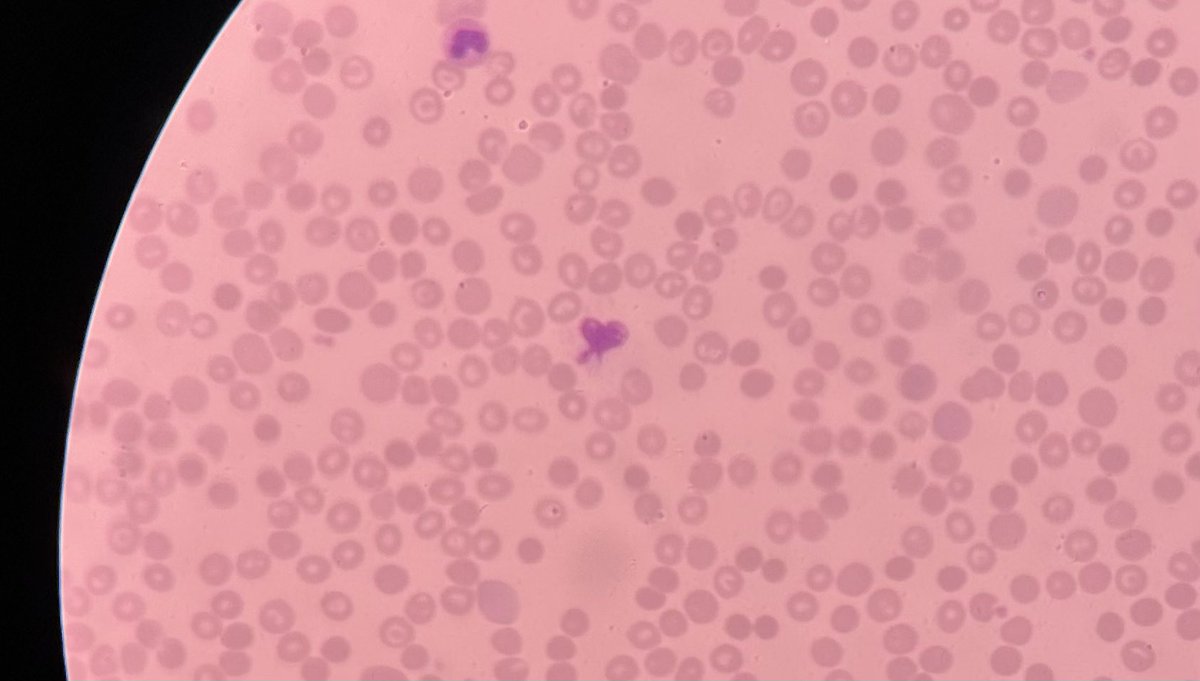 كيف استفتحت لاب الهيما 👇🏻