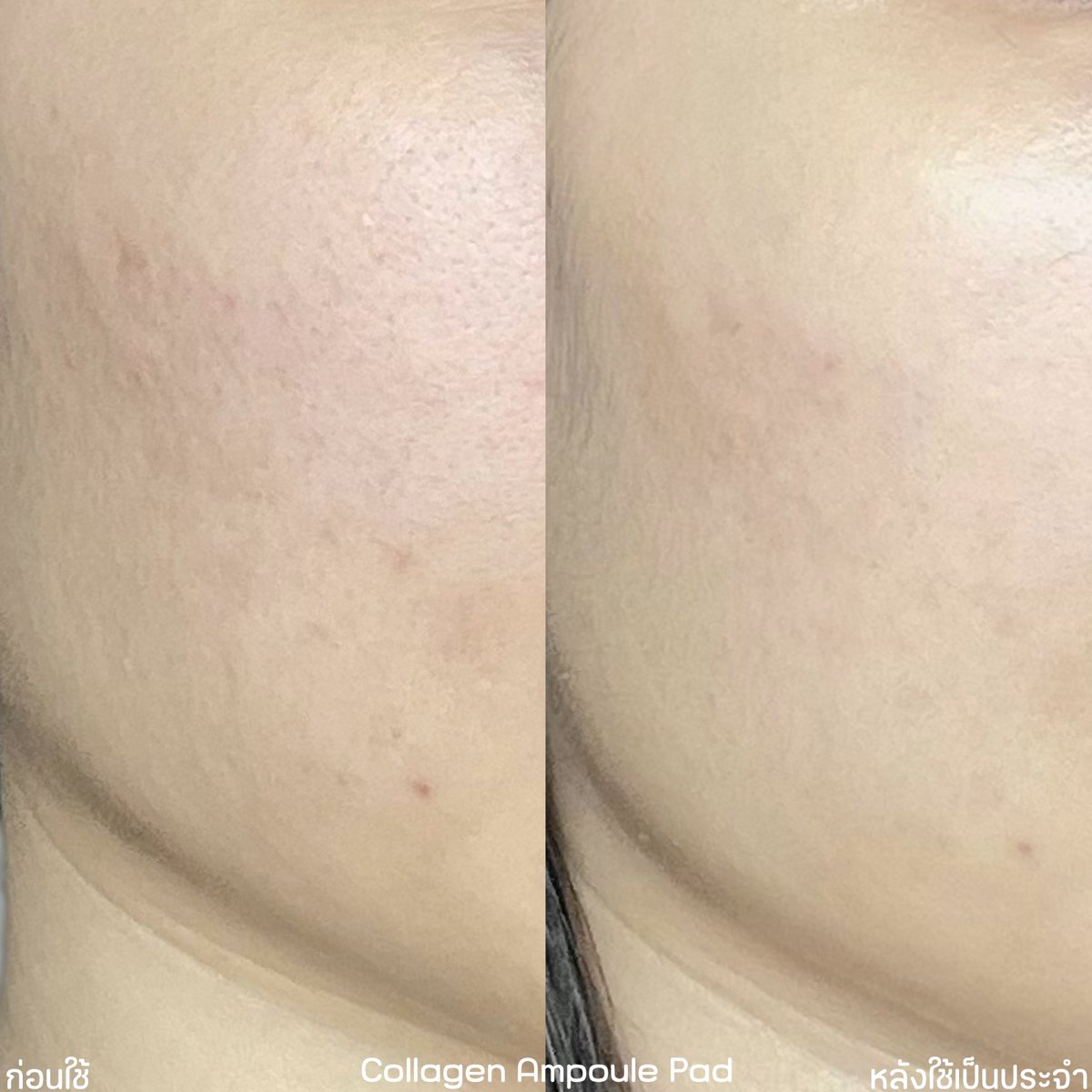 plengssp's tweet image. เปรียบเทียบโทนเนอร์แพดสี่เหลี่ยม #Mediheal สูตรขายดีในเกาหลีและไทย
🩵สีฟ้า Medecassoside อันดับ 1 ในเกาหลี เน้นลดสิว รอยสิว ปลอบผิว แพดคล้ายตาข่ายถี่ๆ
🩷สีชมพู Collagen Ampoule อันดับ 1 ในไทย ช่วยให้ผิวดูเรียบเนียน เต่งตึง กระชับ แพดจะเนียนนุ่ม…