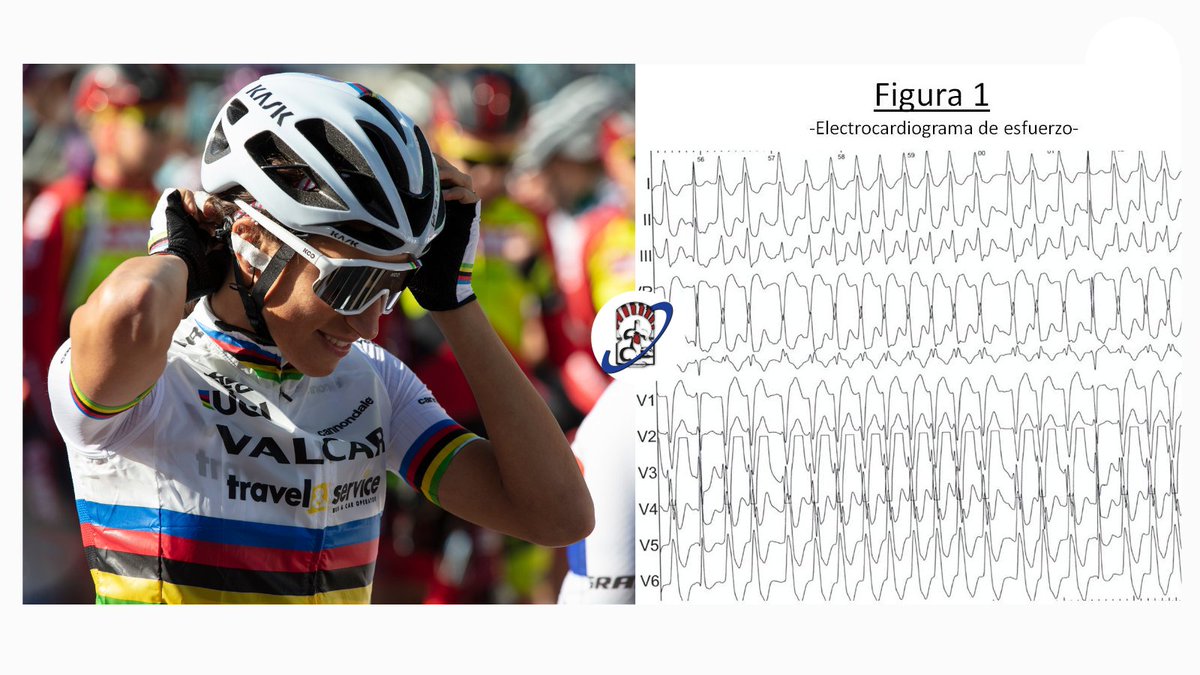 🏥#casoclinico 

En ocasiones, algunas pruebas rutinarias como la #ergometría en deportistas pueden “desorientar” un diagnóstico. 

Es preciso una correcta orientación con examen por especialista para descartar patologías que contraindiquen el esfuerzo 👇
acortar.link/n9CAxP