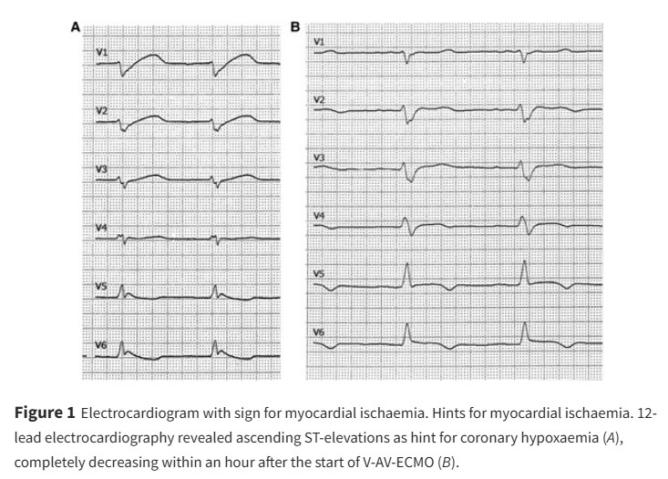European Society of Cardiology Journals (@esc_journals) on Twitter photo Have you heard of "cardiac Harlequin syndrome"? Find out more here: ow.ly/ZYqq50WOeJA
#EHJCaseReports #CardioX <a href="/Phiso_de/">Philipp Sommer</a> <a href="/TJ_Yeo/">Tee Joo YEO</a> <a href="/aayshacader/">Aaysha Cader</a> <a href="/BoldiKovacsMD/">Boldizsar Kovacs</a> <a href="/KardiologieHH/">Erik Rafflenbeul</a> <a href="/ANazmiCalik/">A.Nazmi Calik</a> <a href="/O_Azizy_MD/">Obayda Azizy</a> <a href="/saramoscatelli7/">Sara Moscatelli</a> <a href="/EHJCREiC/">EHJCaseReports Editor-in-Chief</a> Have you heard of "cardiac Harlequin syndrome"? Find out more here: ow.ly/ZYqq50WOeJA
#EHJCaseReports #CardioX <a href="/Phiso_de/">Philipp Sommer</a> <a href="/TJ_Yeo/">Tee Joo YEO</a> <a href="/aayshacader/">Aaysha Cader</a> <a href="/BoldiKovacsMD/">Boldizsar Kovacs</a> <a href="/KardiologieHH/">Erik Rafflenbeul</a> <a href="/ANazmiCalik/">A.Nazmi Calik</a> <a href="/O_Azizy_MD/">Obayda Azizy</a> <a href="/saramoscatelli7/">Sara Moscatelli</a> <a href="/EHJCREiC/">EHJCaseReports Editor-in-Chief</a>