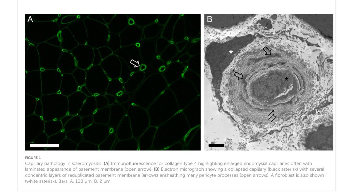 🔥 Scleromyositis – a distinct autoimmune entity!
•🧩 Not just an overlap – sits between systemic sclerosis (SSc) &amp; autoimmune myositis (AIM).
•💪 Muscle weakness: proximal &gt; distal, sometimes axial (→ head drop, camptocormia).
•🫁🫀 Extra-muscular hits: ILD (up to 68%),
