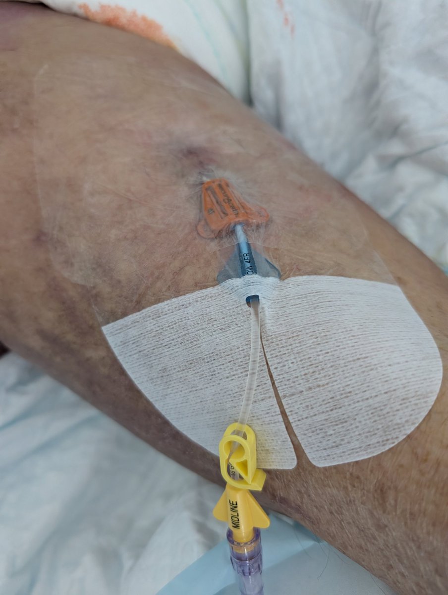 Midline femoral  como alternativa cuando el paciente por su patología no tolera la abducción de MMSS. El acceso femoral evita movilizar y causar dolor en pacientes en los que queremos maximizar el confort como los pacientes paliativos en situación de últimos días.